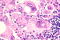 Melanoma cancer cells icon